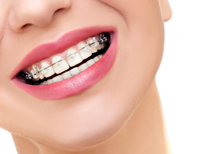 Five Reasons Your Child May Need Braces in the Future  