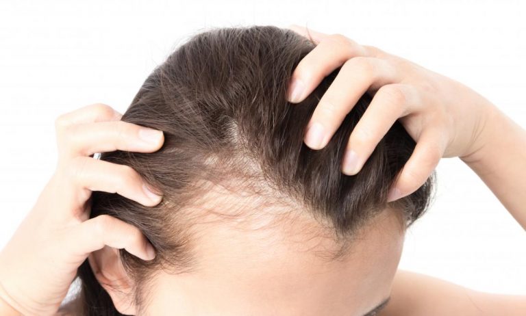 Minoxidil for treatment of male & female baldness