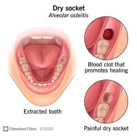 Unveiling: What Does A Wisdom Tooth Clot Look Like