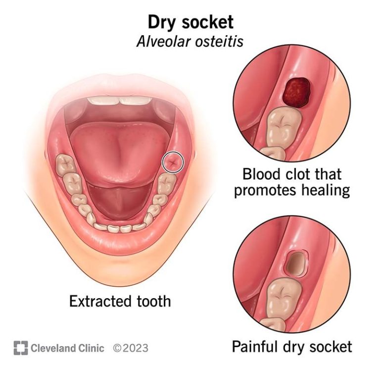 Unveiling: What Does A Wisdom Tooth Clot Look Like
