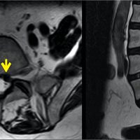 Understanding Thecal Sac Indentation: A Comprehensive Guide